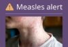 HEALTH ALERT: Measles case detected in Toowoomba